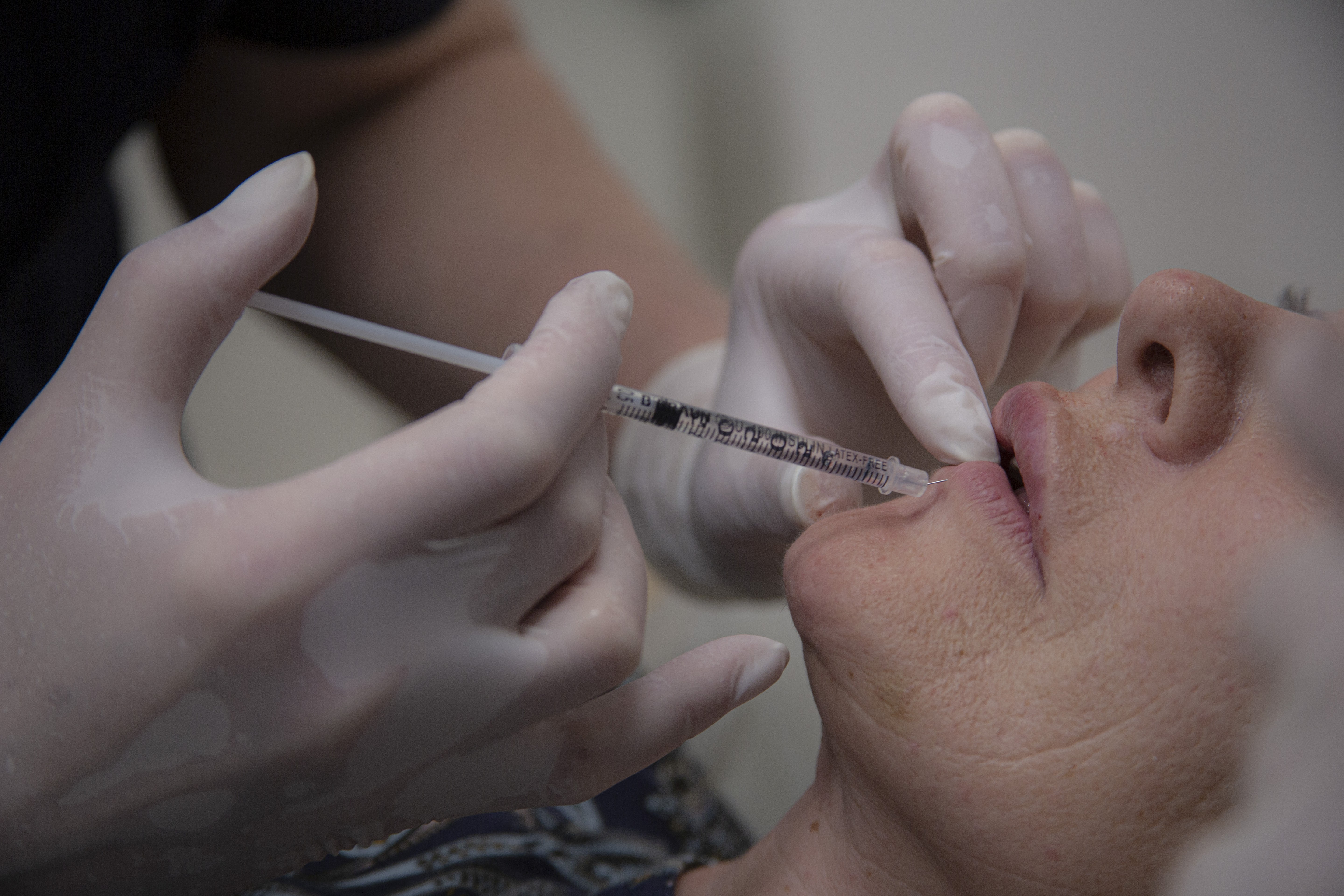 Клинические ошибки при работе с гиалуроновой кислотой