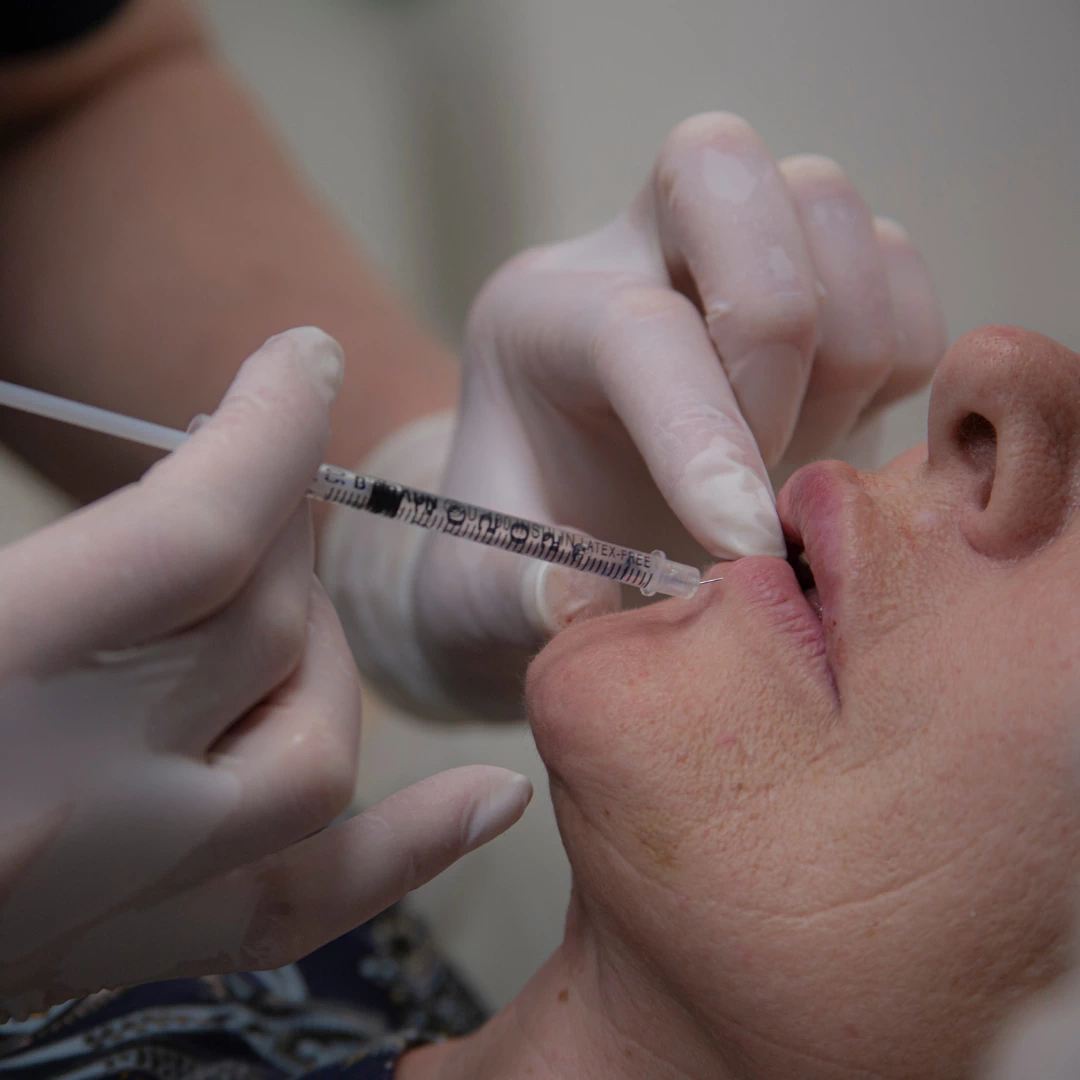 Топ-5 ошибок косметологов при работе с губами: причины и разбор